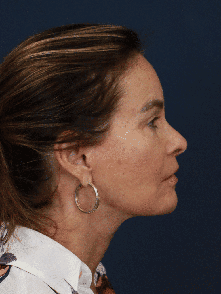 After Image: Deep Plane Face and Neck lift with Platysmaplasty, Lip lift, Brow Lift, Facial Fat Grafting - right-side