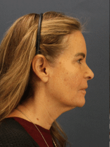 Before Image: Deep Plane Face and Neck lift, Lip lift, Endoscopic Brow Lift & Facial Fat Grafting