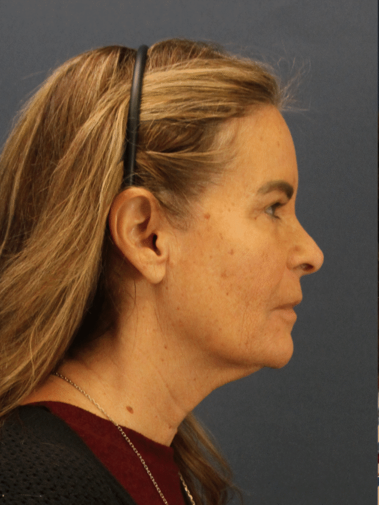 Before Image: Deep Plane Face and Neck lift with Platysmaplasty, Lip lift, Brow Lift, Facial Fat Grafting - right-side