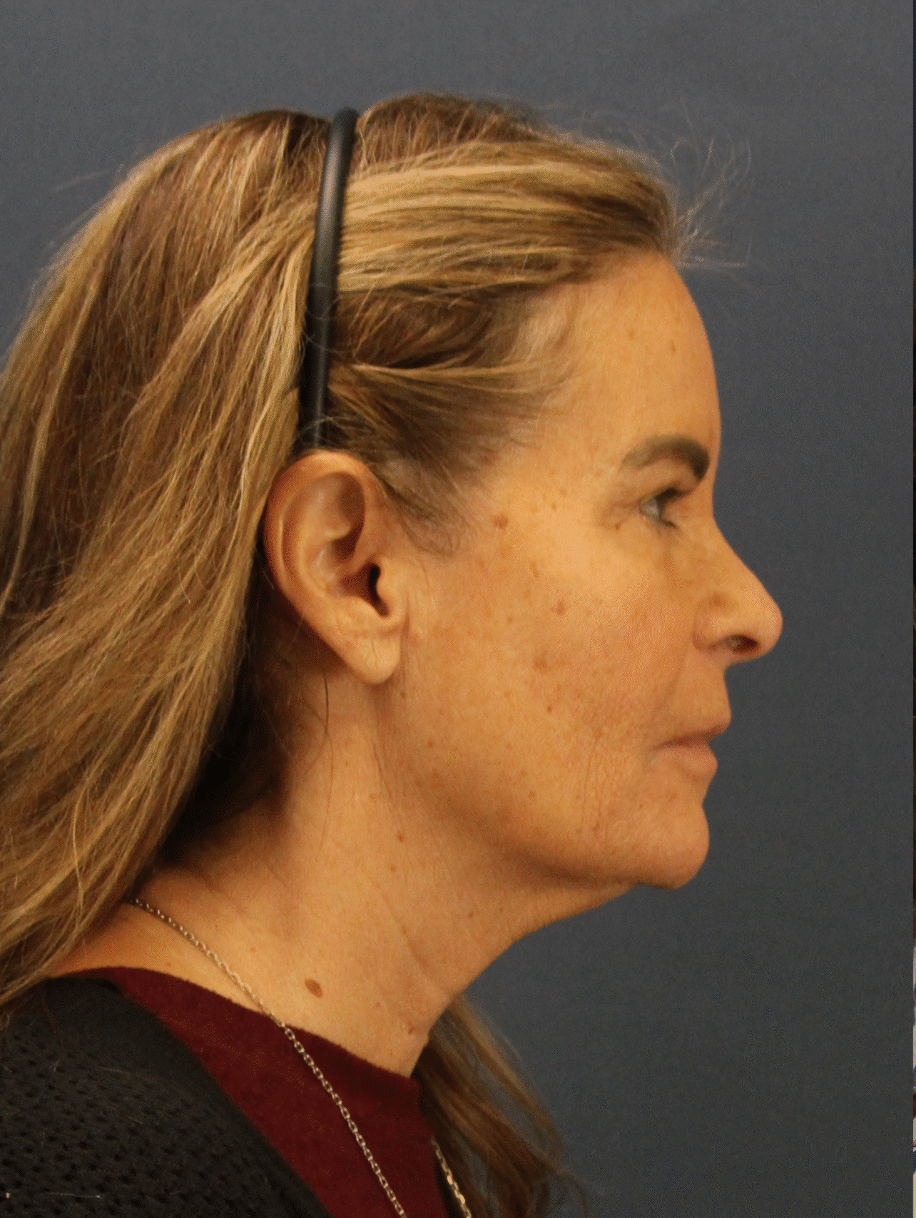Before Image: Deep Plane Face and Neck lift, Lip lift, Endoscopic Brow Lift & Facial Fat Grafting - right-side