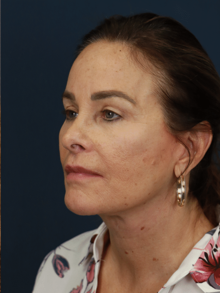 After Image: Deep Plane Face and Neck lift with Platysmaplasty, Lip lift, Brow Lift, Facial Fat Grafting - left-back-oblique