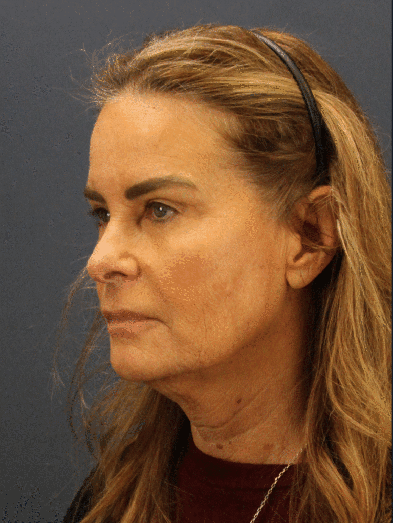 Before Image: Deep Plane Face and Neck lift with Platysmaplasty, Lip lift, Brow Lift, Facial Fat Grafting - left-back-oblique
