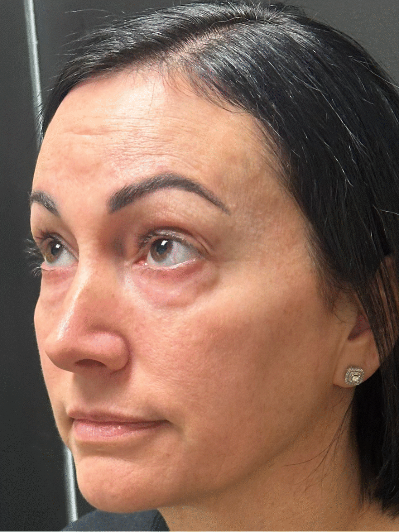 Before Image: Lower lid blepharoplasty and Upper lid blepharoplasty - left-front-oblique