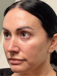 After Image: Lower lid blepharoplasty and Upper lid blepharoplasty