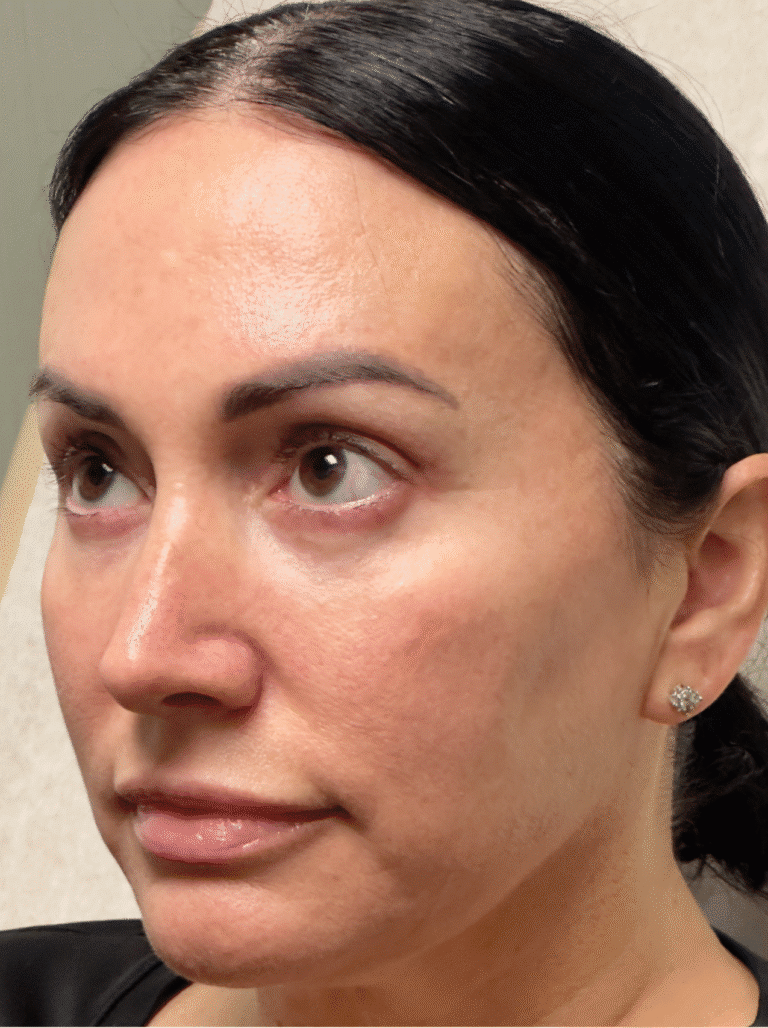 After Image: Lower lid blepharoplasty and Upper lid blepharoplasty - left-front-oblique