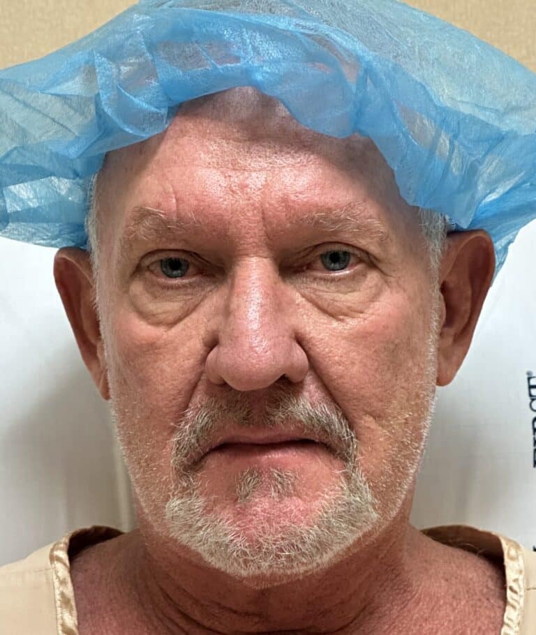 Before Image: Lower Eyelid Lift w/ Fat Transposition & Lid Tightening, Facial Fat Grafting - front