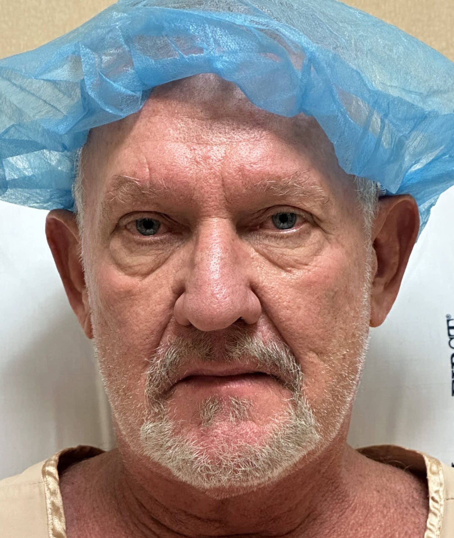 Before Image: Lower Eyelid Lift w/ Fat Transposition & Lid Tightening, Facial Fat Grafting - front