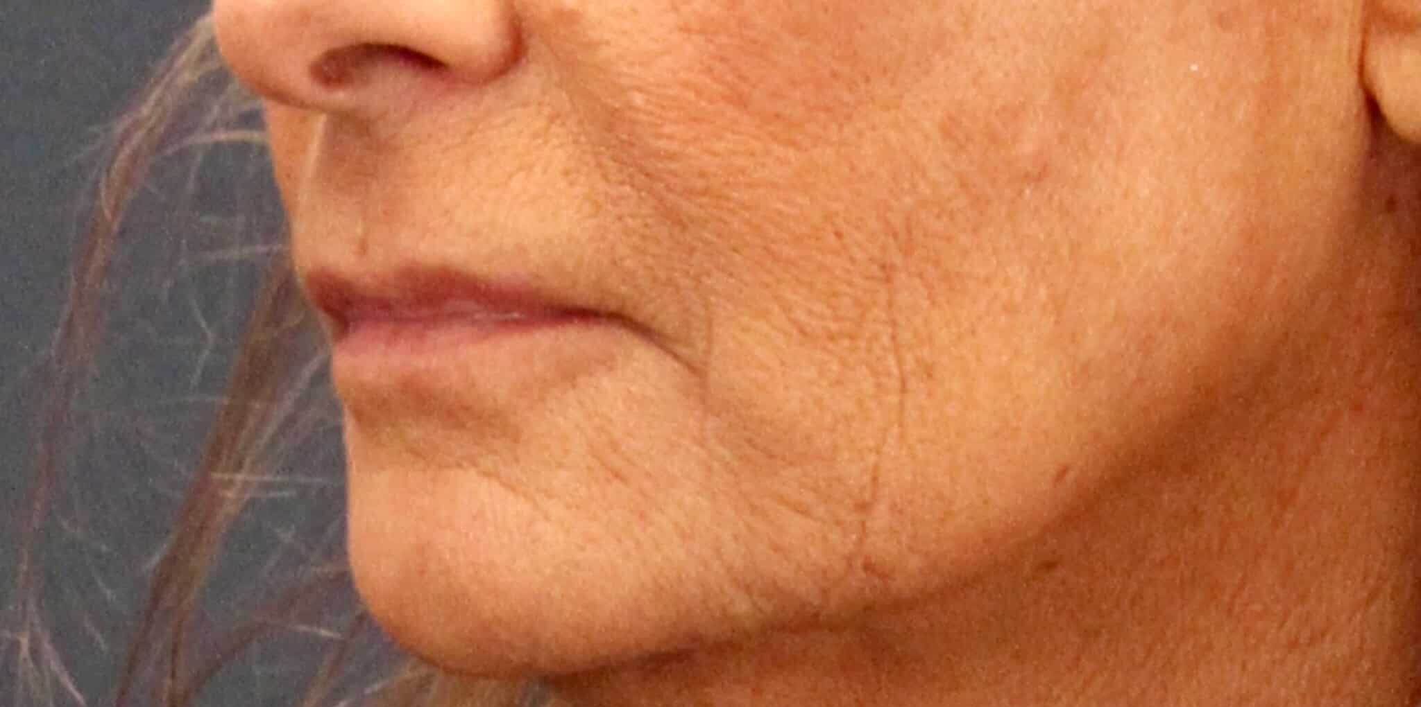 Before Image: Bullhorn & Corner Lip lift - left-front-oblique