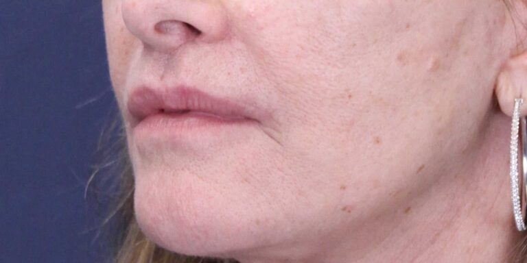 After Image: Bullhorn & Corner Lip lift - left-front-oblique