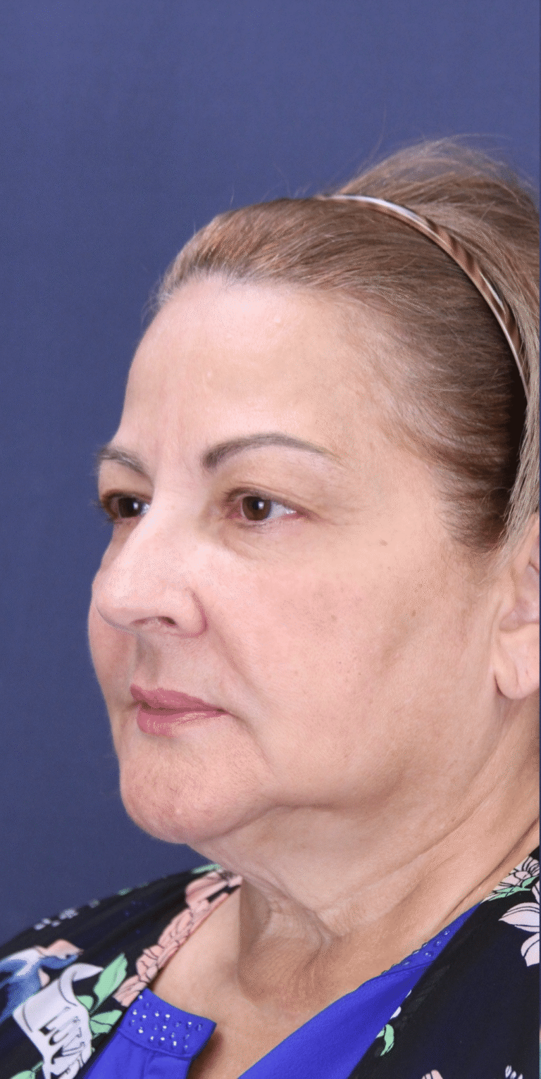 Before Image: Upper Blepharoplasty - left-front-oblique