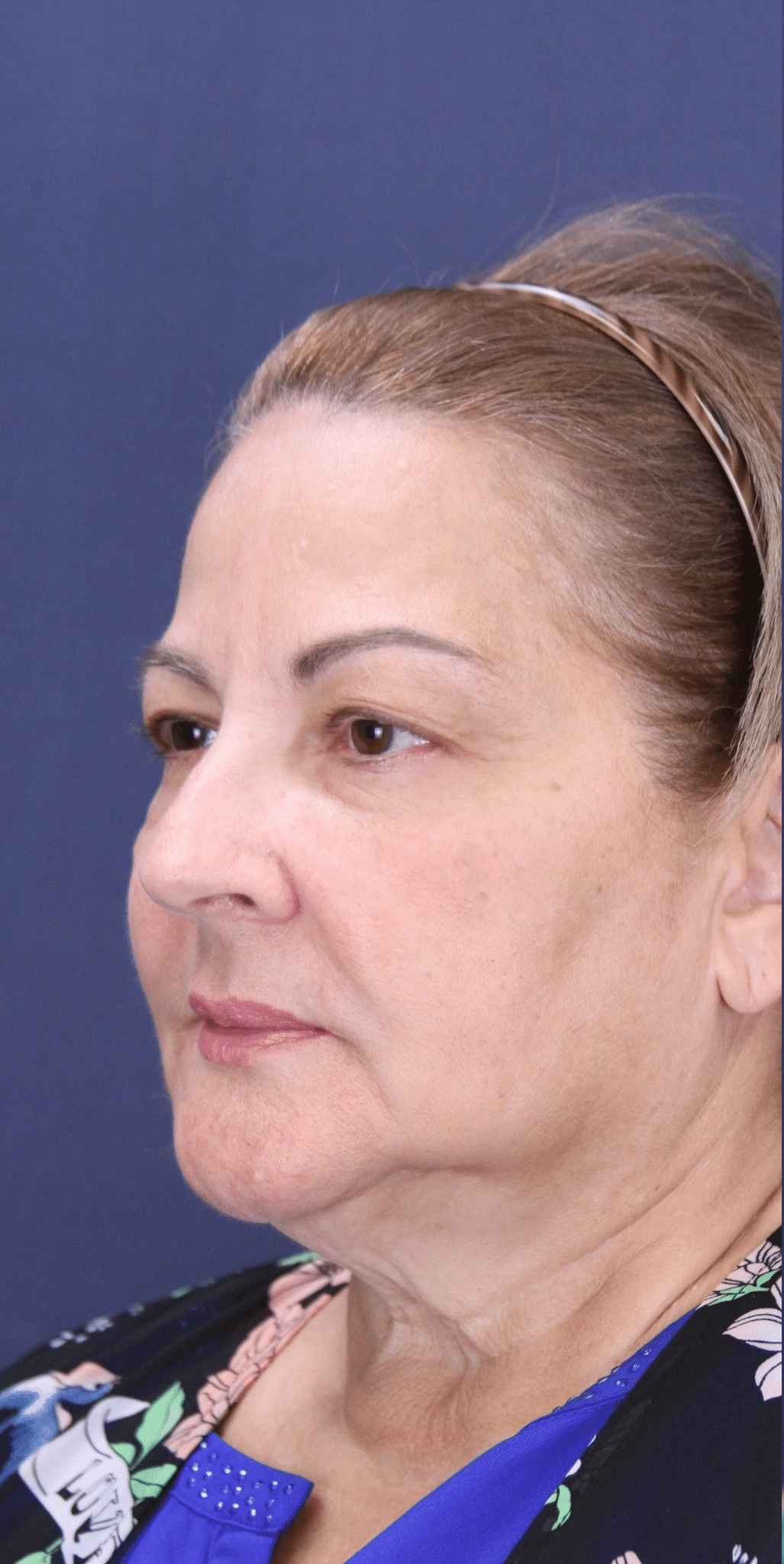 Before Image: Upper Blepharoplasty - left-front-oblique