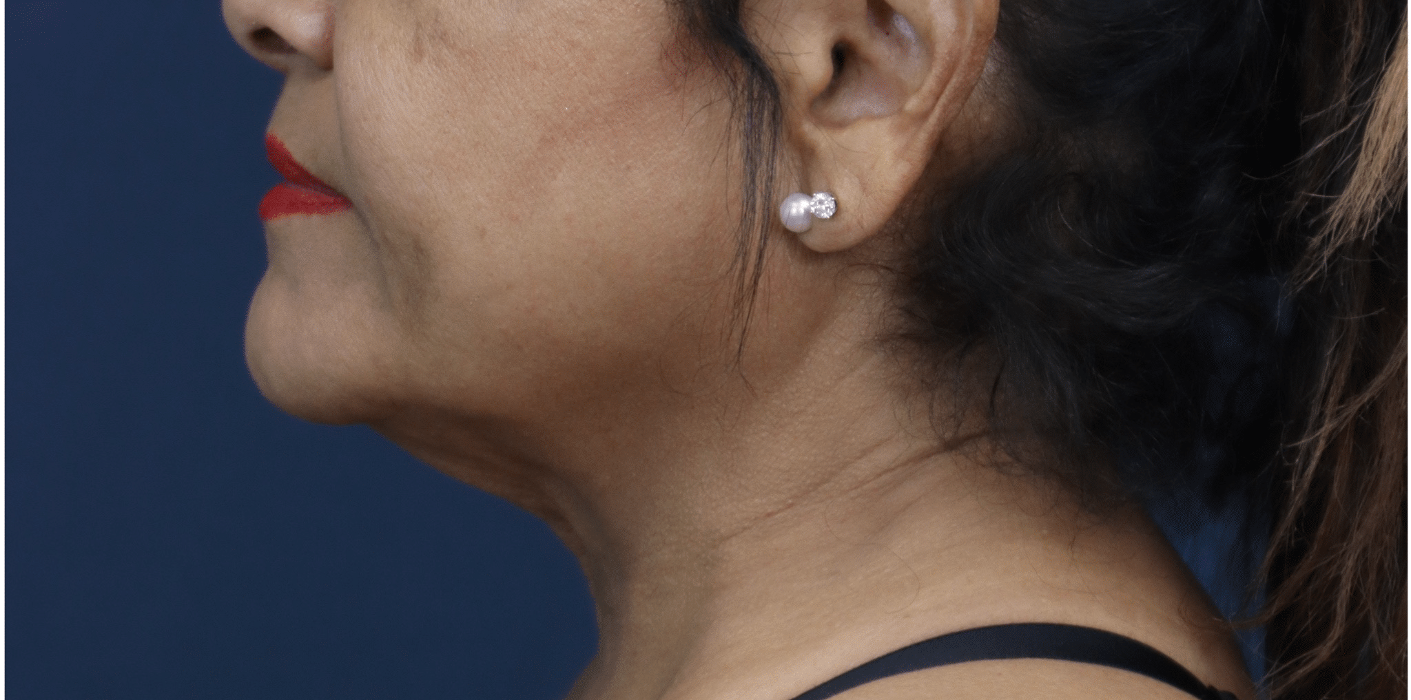 Before Image: Facelift, Extended Deep Plane Neck Lift