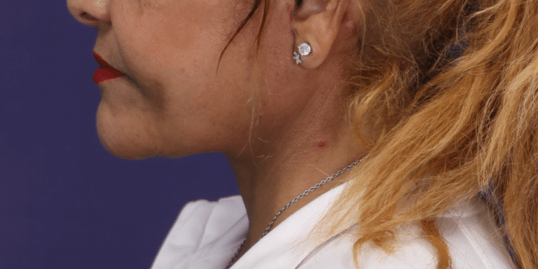 After Image: Facelift, Extended Deep Plane Neck Lift - left-side