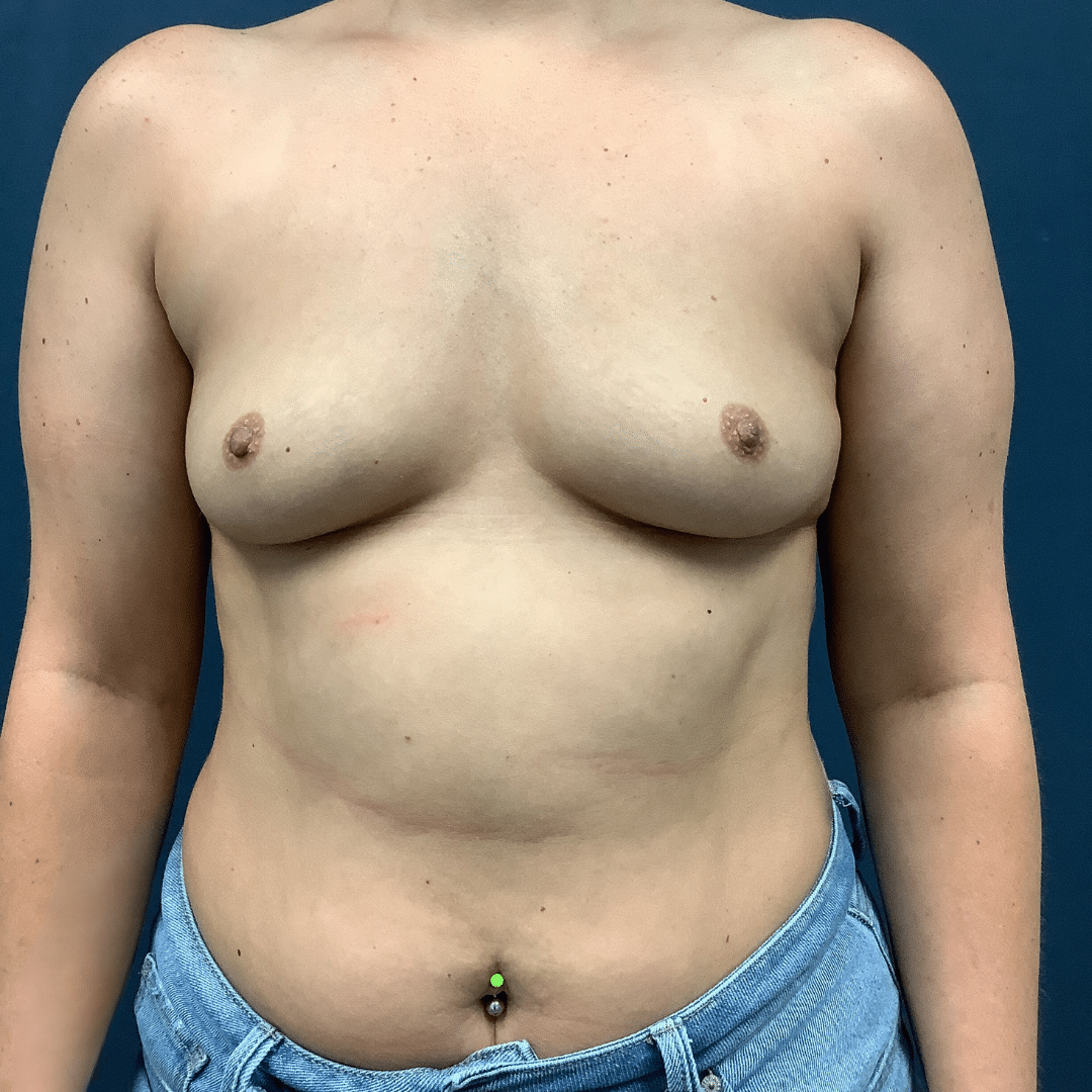 Before Image: Breast Augmentation - front