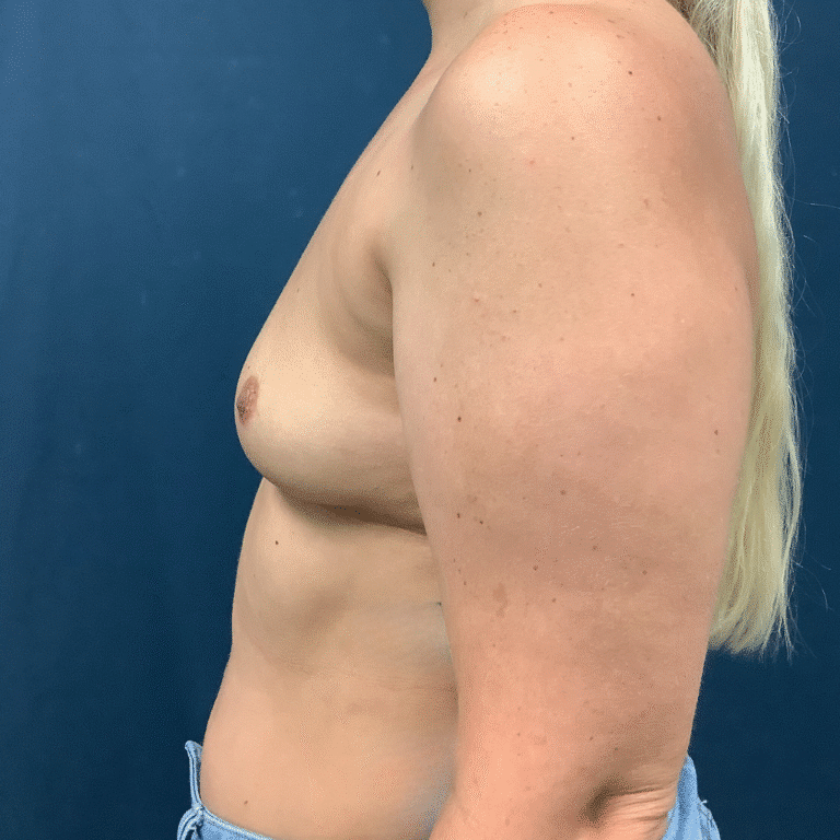 Before Image: Breast Augmentation - left-side