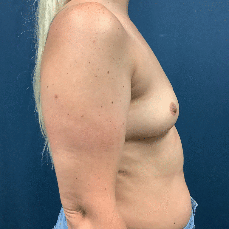 Before Image: Breast Augmentation - right-side