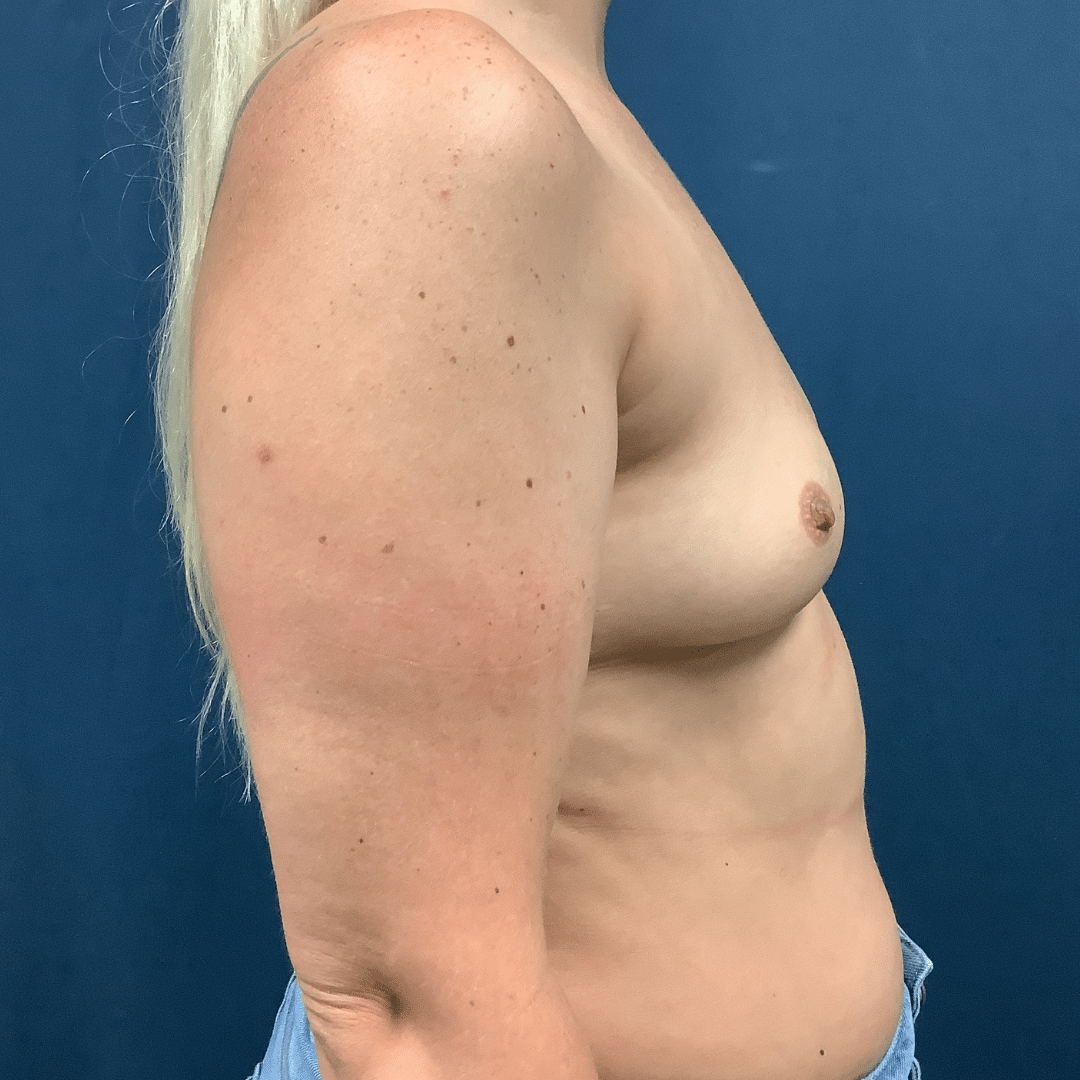 Before Image: Breast Augmentation - right-side
