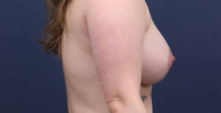 After Image: Breast Augmentation - right-side
