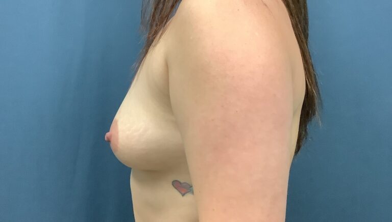 Before Image: Breast Augmentation - left-side