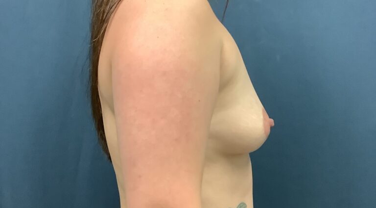 Before Image: Breast Augmentation - right-side
