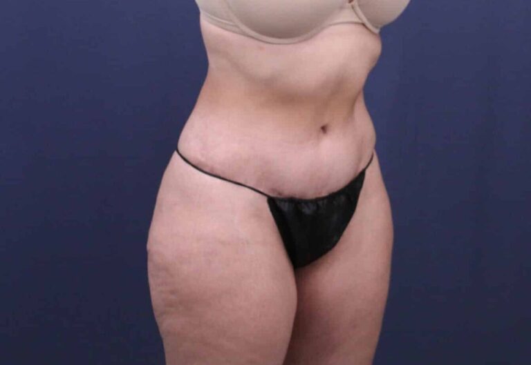 After Image: Bella Body Lift - right-front-oblique