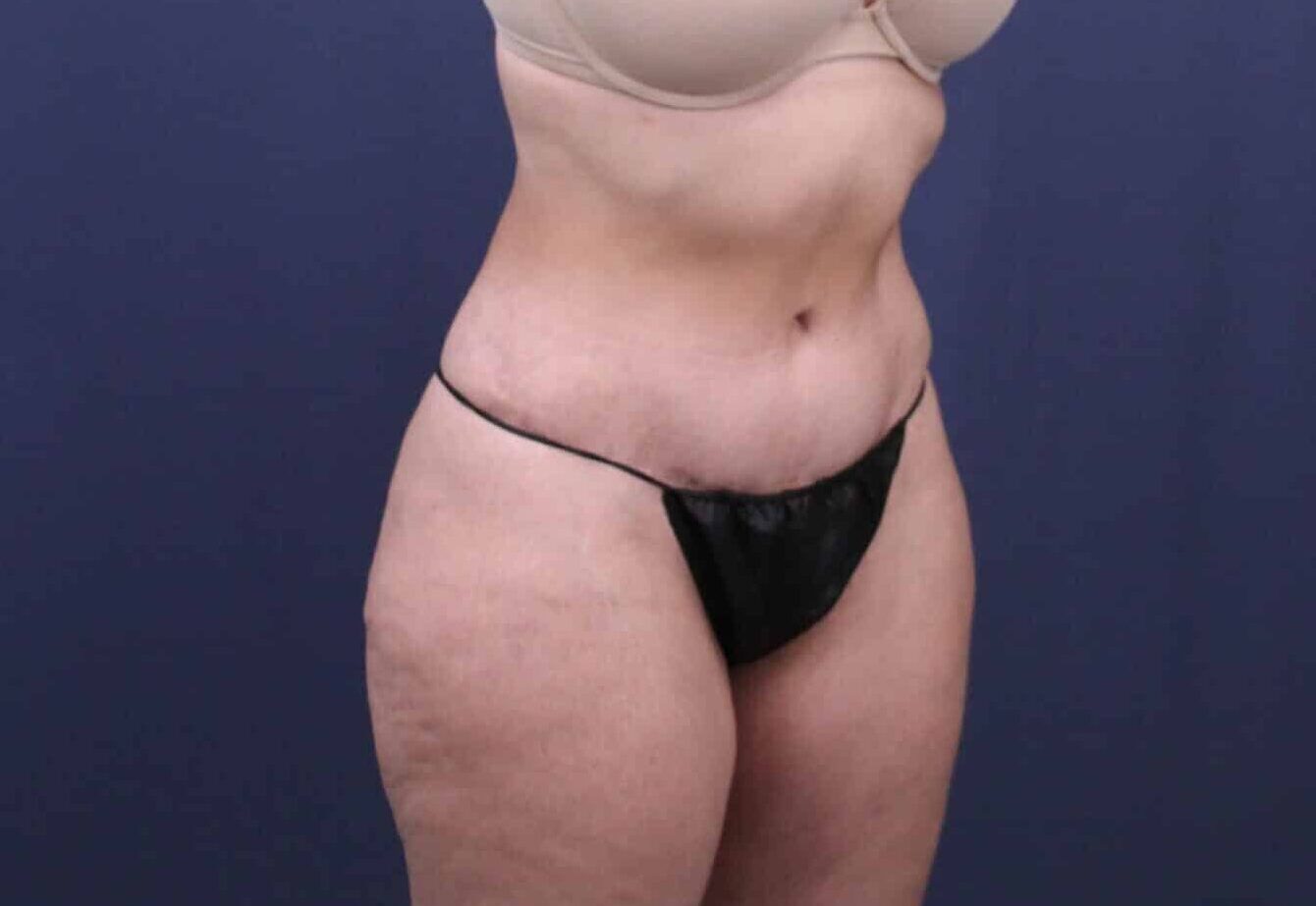 After Image: Bella Body Lift - right-front-oblique