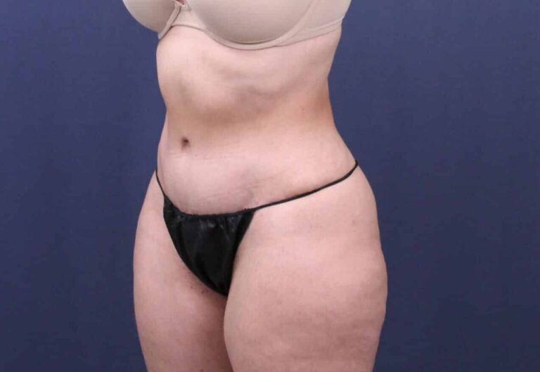 After Image: Bella Body Lift - left-front-oblique