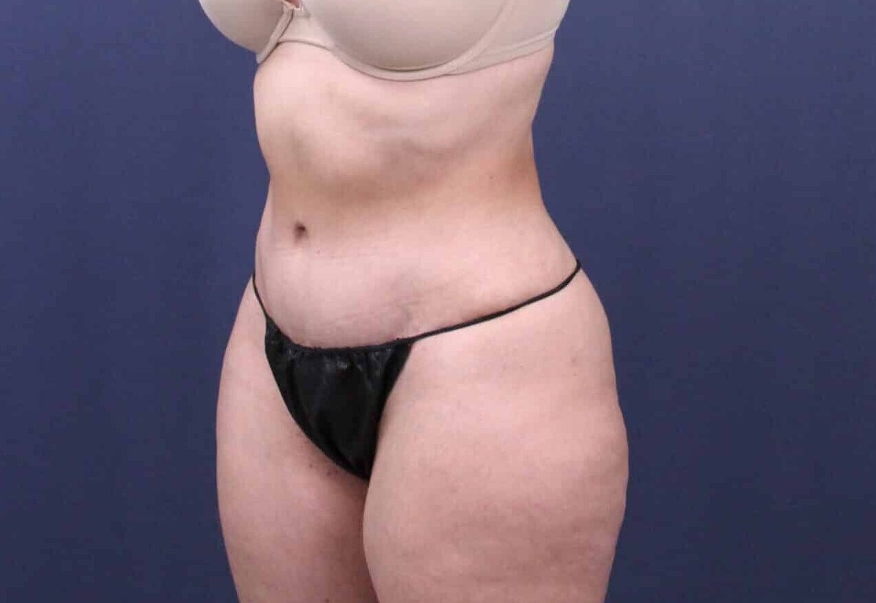 After Image: Bella Body Lift - left-front-oblique