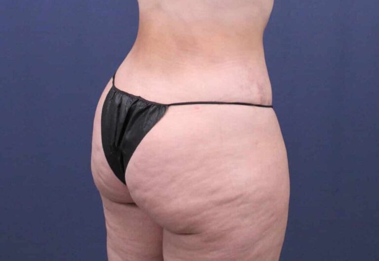 After Image: Bella Body Lift - right-back-oblique