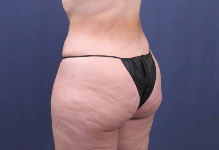 After Image: Bella Body Lift - left-back-oblique