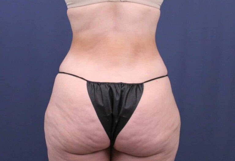 After Image: Bella Body Lift - back