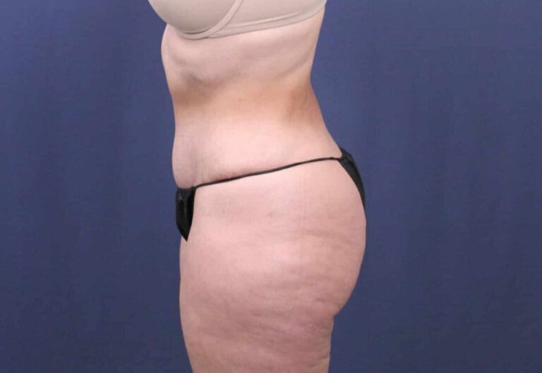 After Image: Bella Body Lift - left-side
