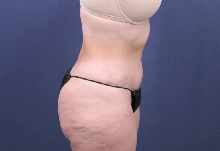 After Image: Bella Body Lift - right-side