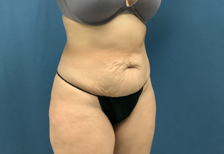 Before Image: Bella Body Lift - right-front-oblique