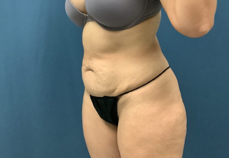 Before Image: Bella Body Lift - left-front-oblique