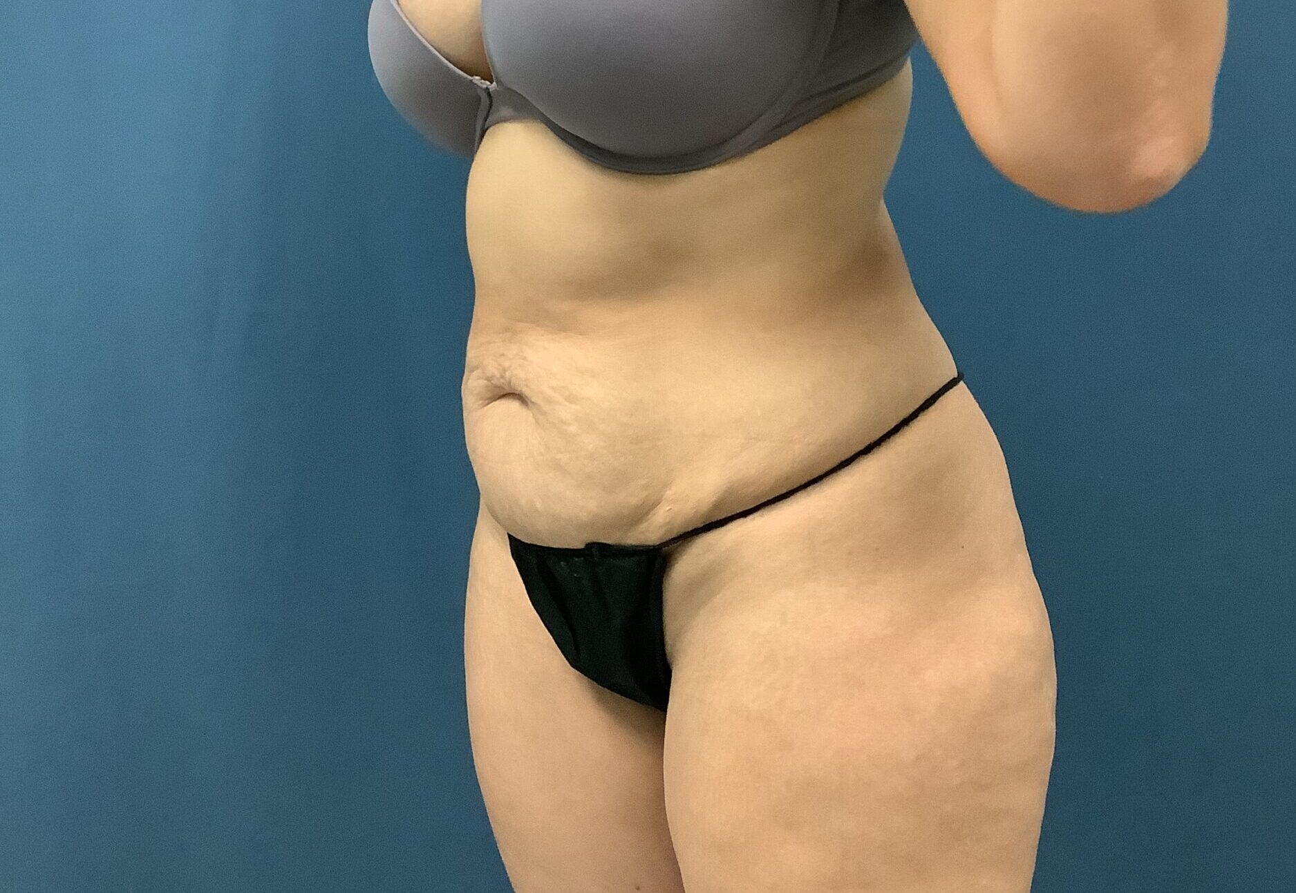 Before Image: Bella Body Lift - left-front-oblique