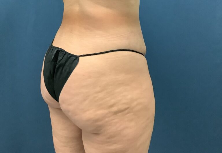 Before Image: Bella Body Lift - right-back-oblique