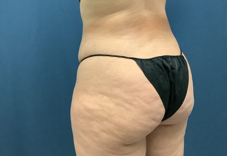 Before Image: Bella Body Lift - left-back-oblique