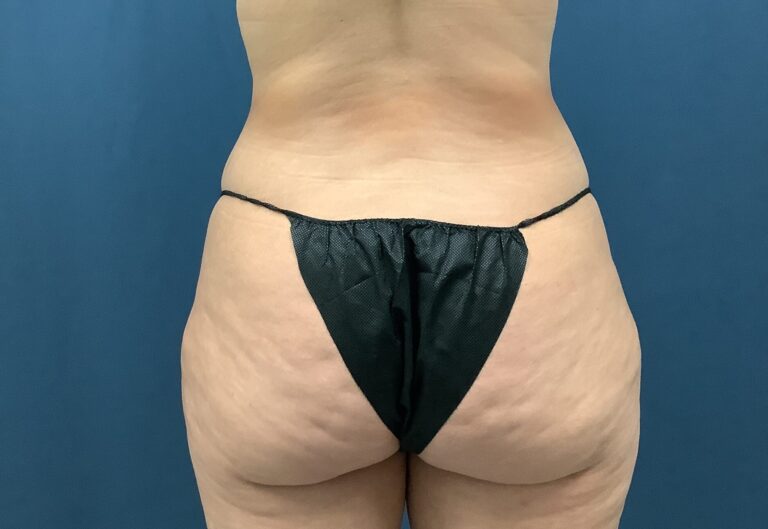 Before Image: Bella Body Lift - back