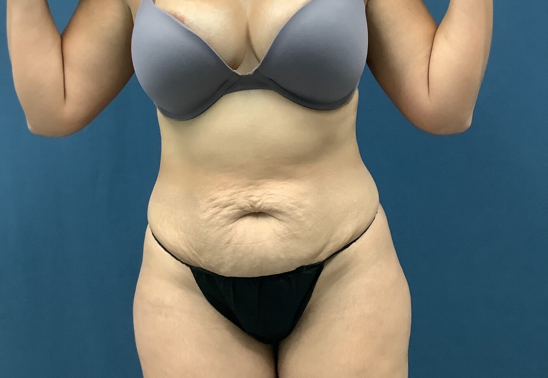 Before Image: Bella Body Lift - front