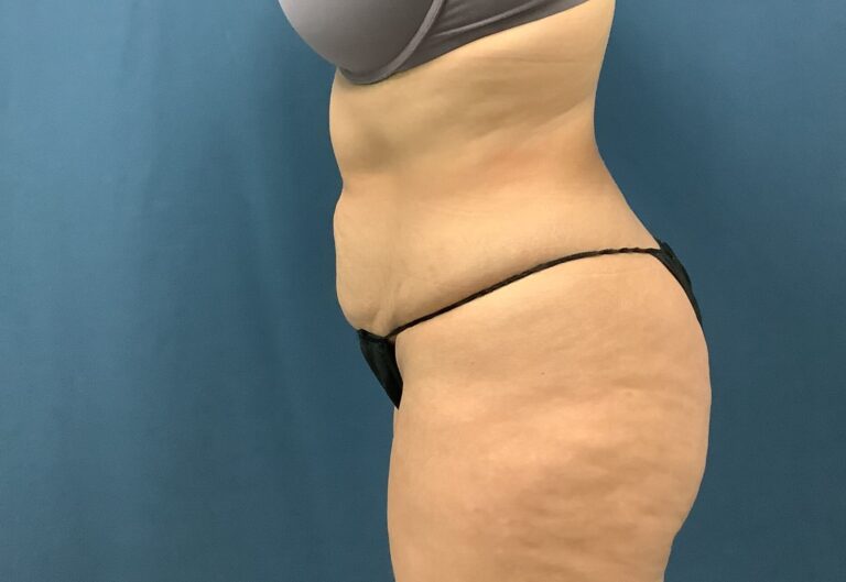 Before Image: Bella Body Lift - left-side