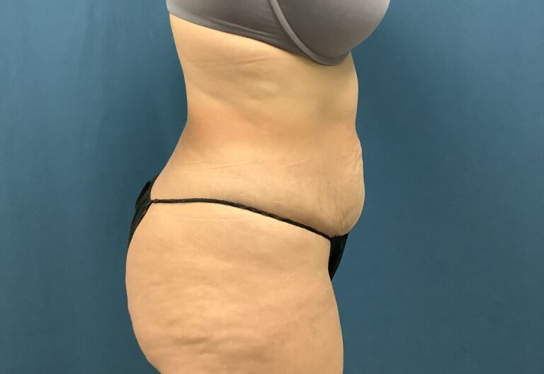 Before Image: Bella Body Lift - right-side