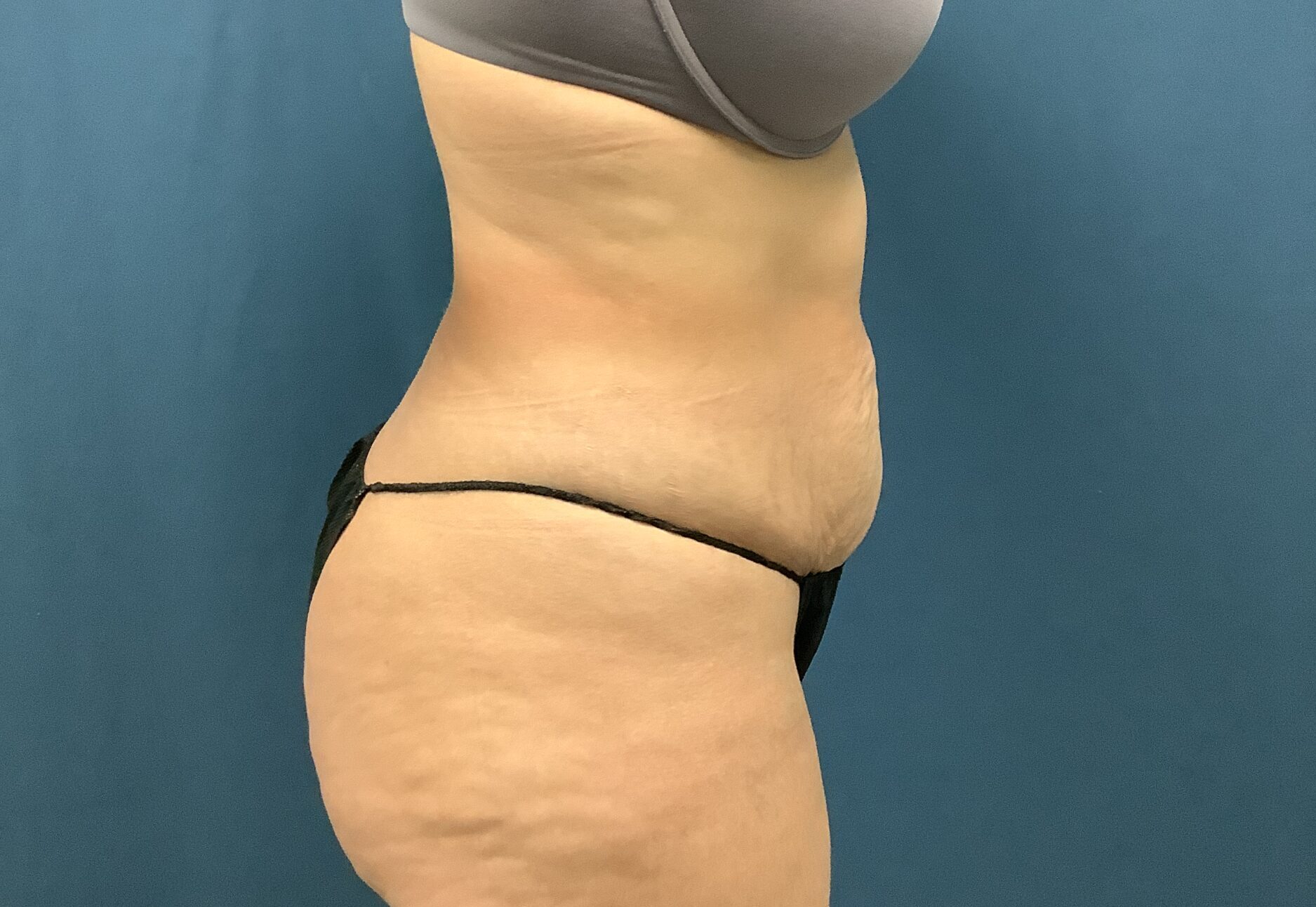 Before Image: Bella Body Lift - right-side