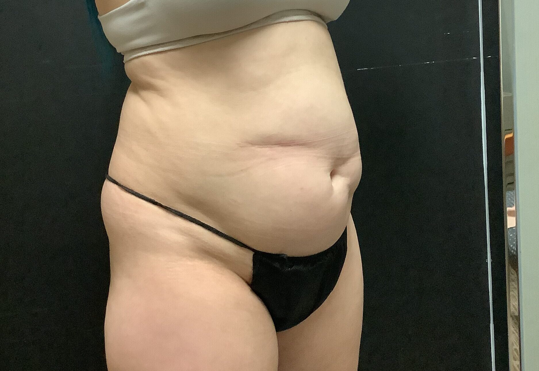 Before Image: Tummy Tuck with Midbody Liposuction - right-front-oblique