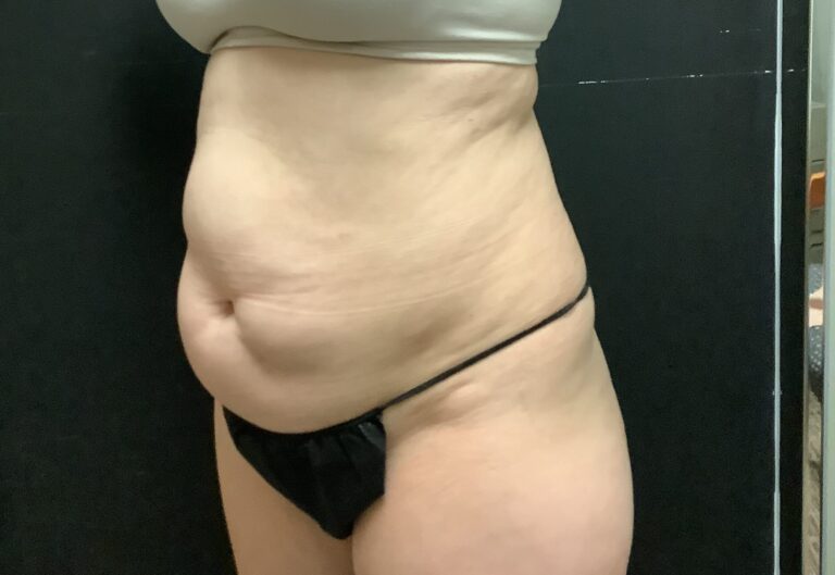 Before Image: Tummy Tuck with Midbody Liposuction - left-front-oblique