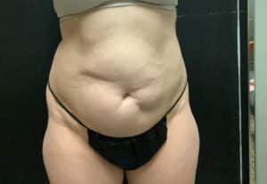 Before Image: Tummy Tuck with Midbody Liposuction