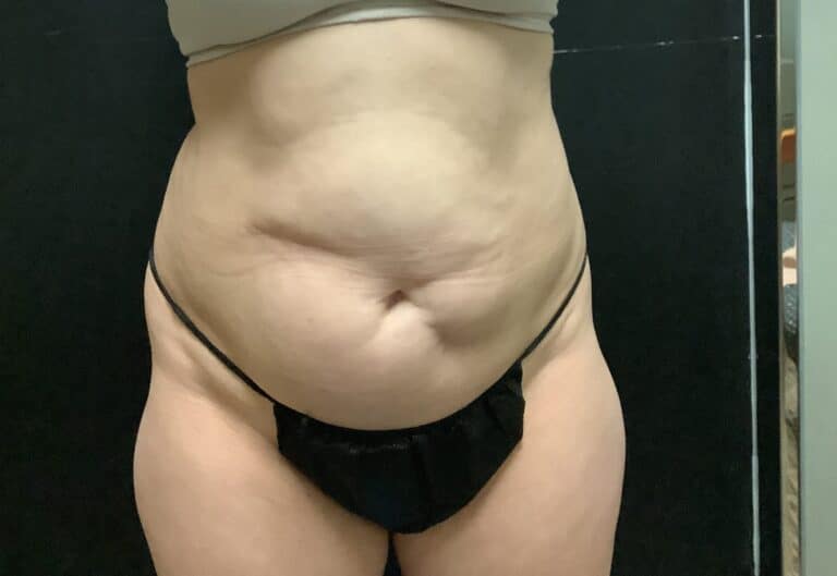 Before Image: Tummy Tuck with Midbody Liposuction - front