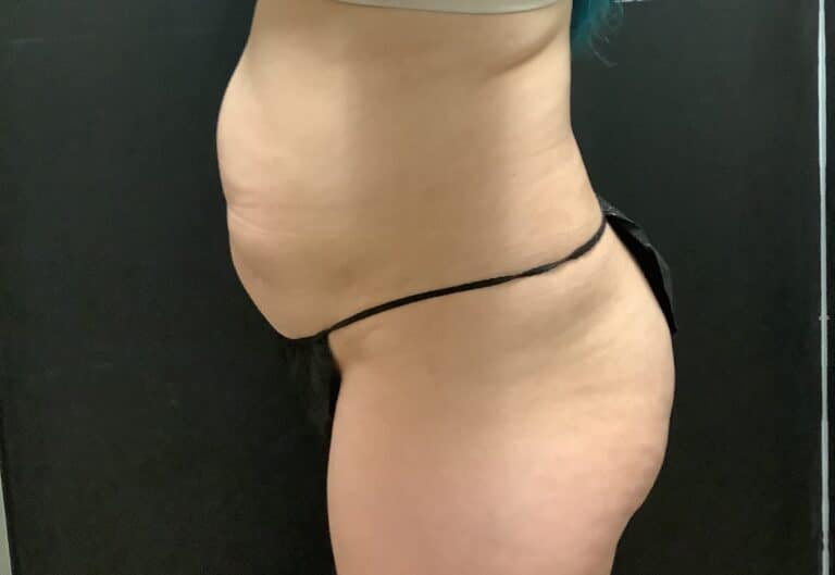 Before Image: Tummy Tuck with Midbody Liposuction - left-side