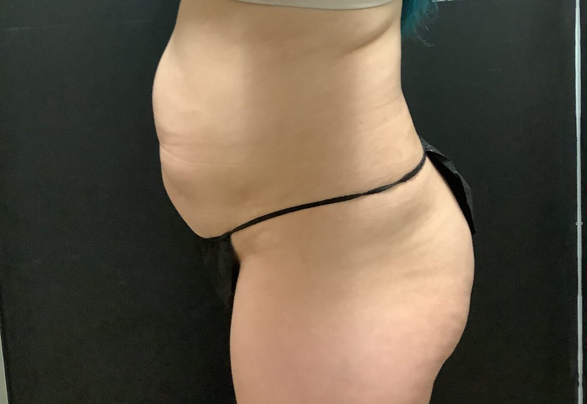 Before Image: Tummy Tuck with Midbody Liposuction - left-side