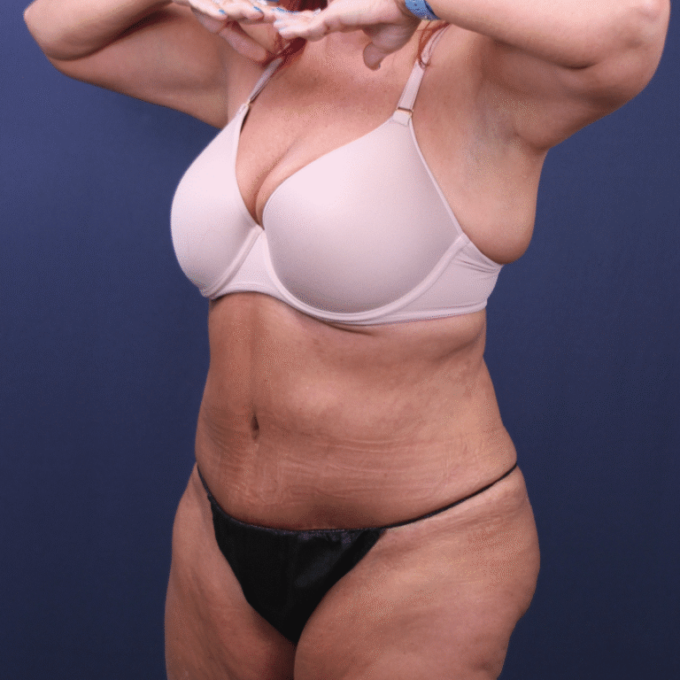 After Image: Extended Bella Body Lift - left-front-oblique